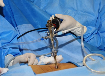 Disc Decompression Surgery Disc Decompression Surgery