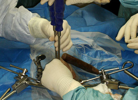 Disc Replacement Surgery Disc Replacement Surgery