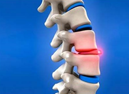 Disc Surgery Faqs Disc Surgery Faqs