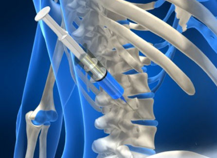 Disc Surgery Information Disc Surgery Information