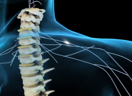 Protruding Disc Surgery